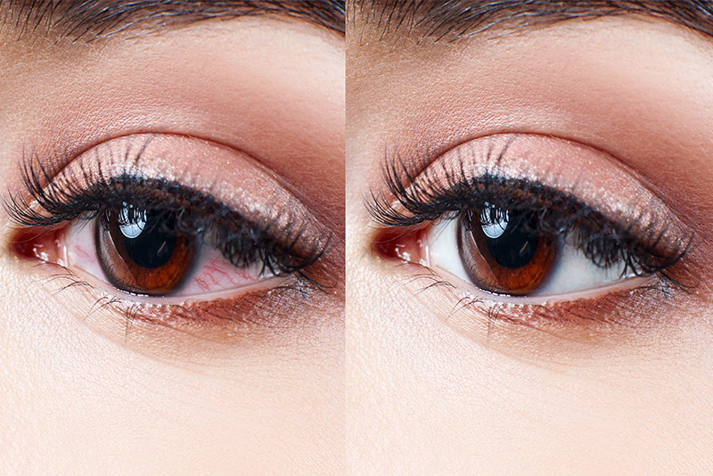 アレルギー性結膜炎